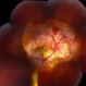 Choroidal Osteoma and Secondary Choroidal Neovascular Membrane Choroidal Osteoma and Secondary Choroidal Neovascular Membrane